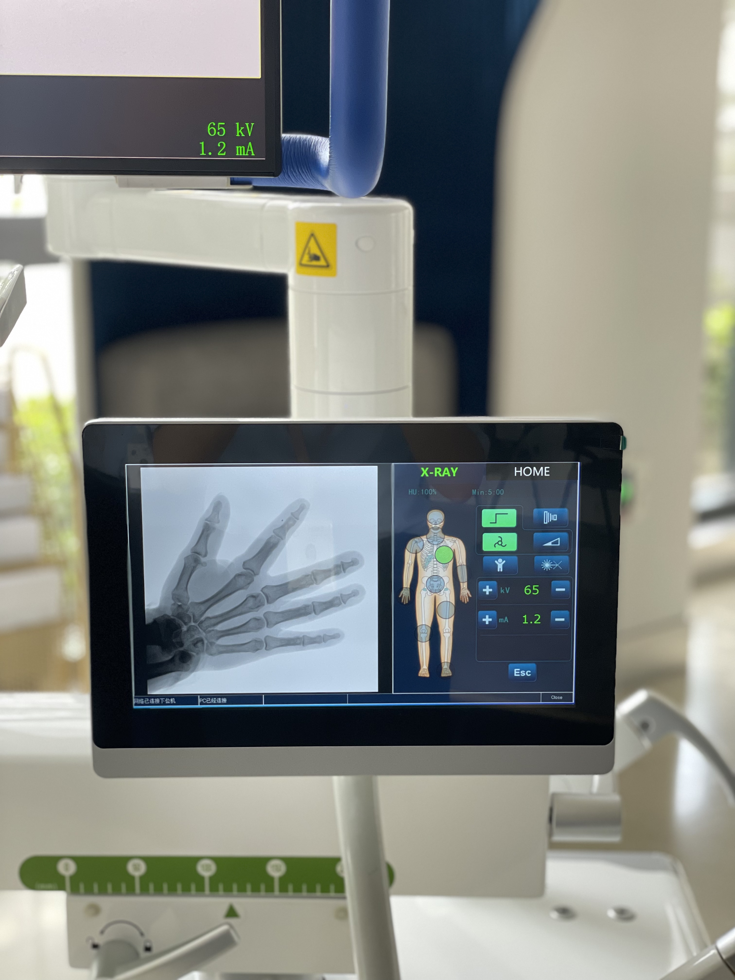 5KW 100mA Digital integrated Dynamic Flat Panel C-arm X-ray Machine -1