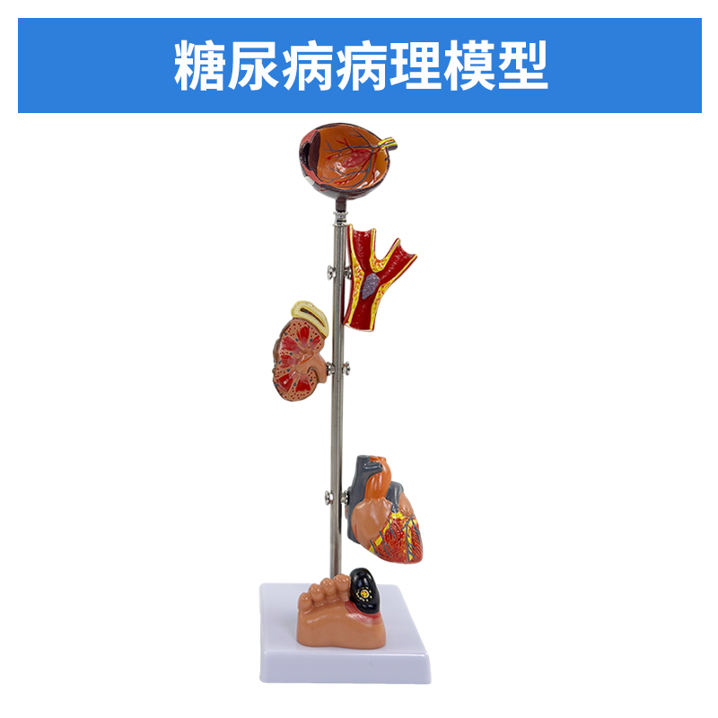 Diabetes model-1