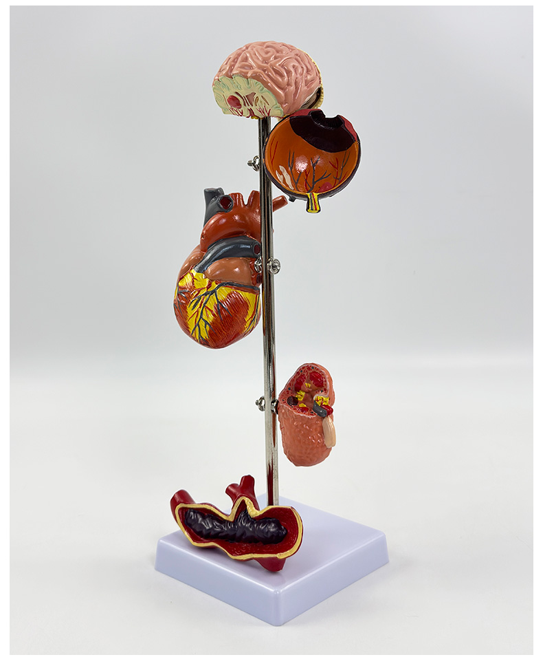 Hypertension model-0