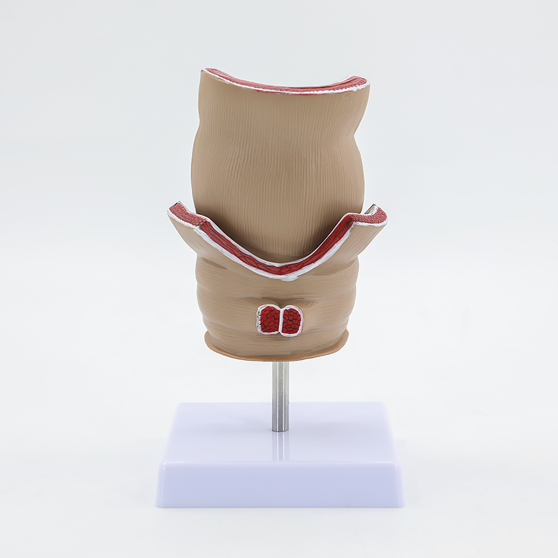 One part: Hemorrhoids (rectum)-0