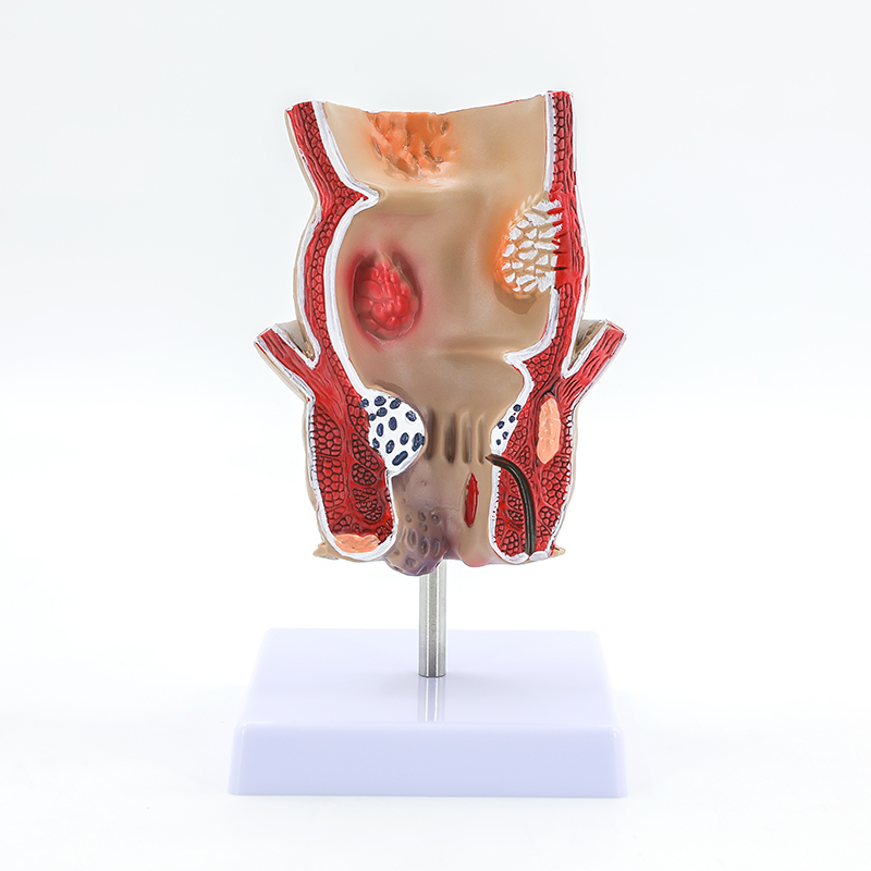 One part: Hemorrhoids (rectum)-1