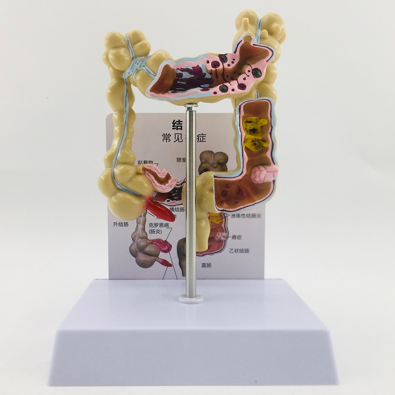 Colon pathological model (small size)-1