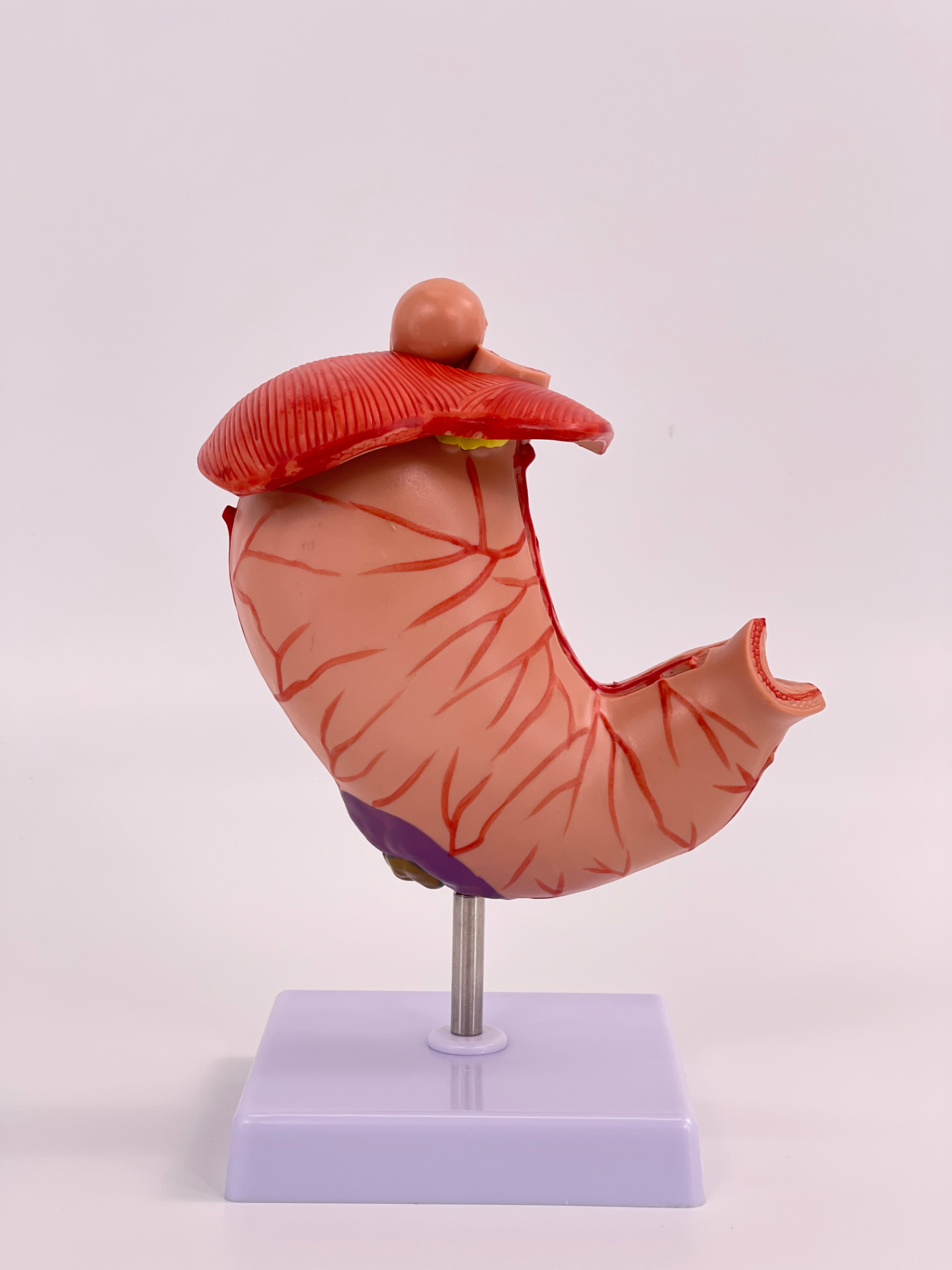 Large pathological stomach-1