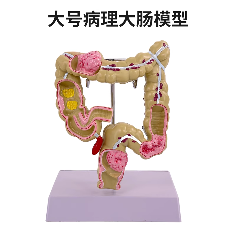 Large intestine pathological model (large size)-1