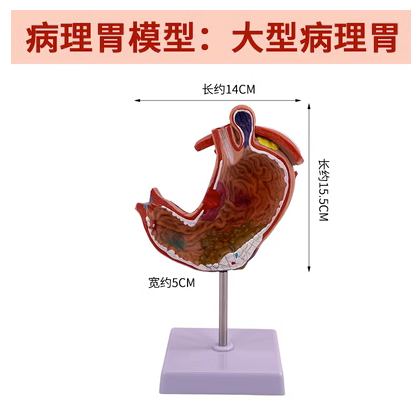 Large pathological stomach-0