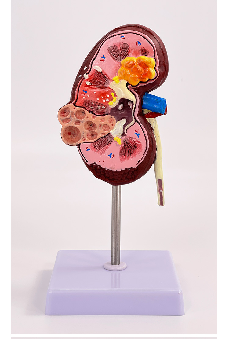 Pathological kidney-1