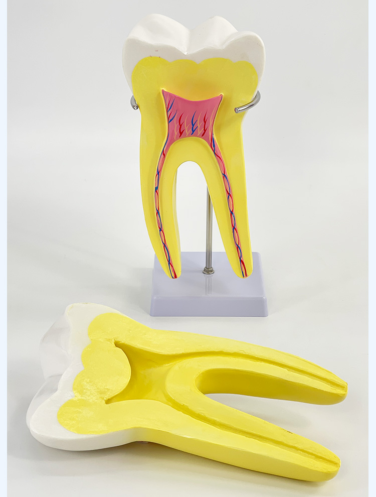 6 Enlarged molars (2 parts)-1