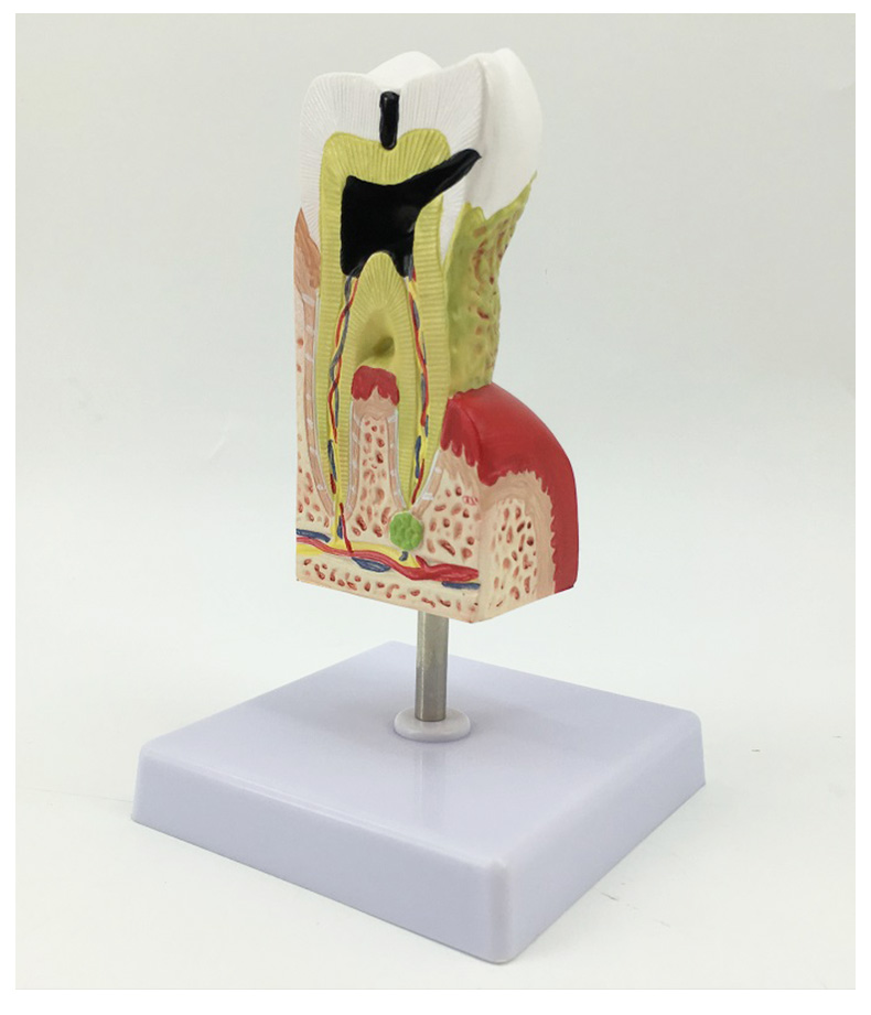 Large tooth decay model-1