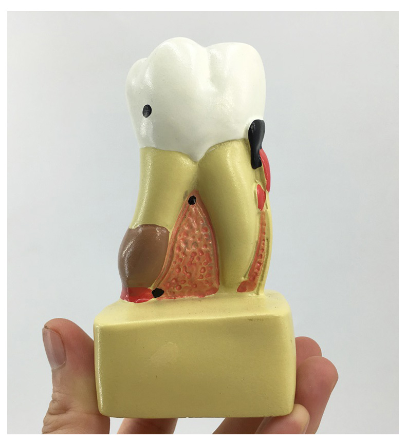 Small-sized decayed tooth model-1