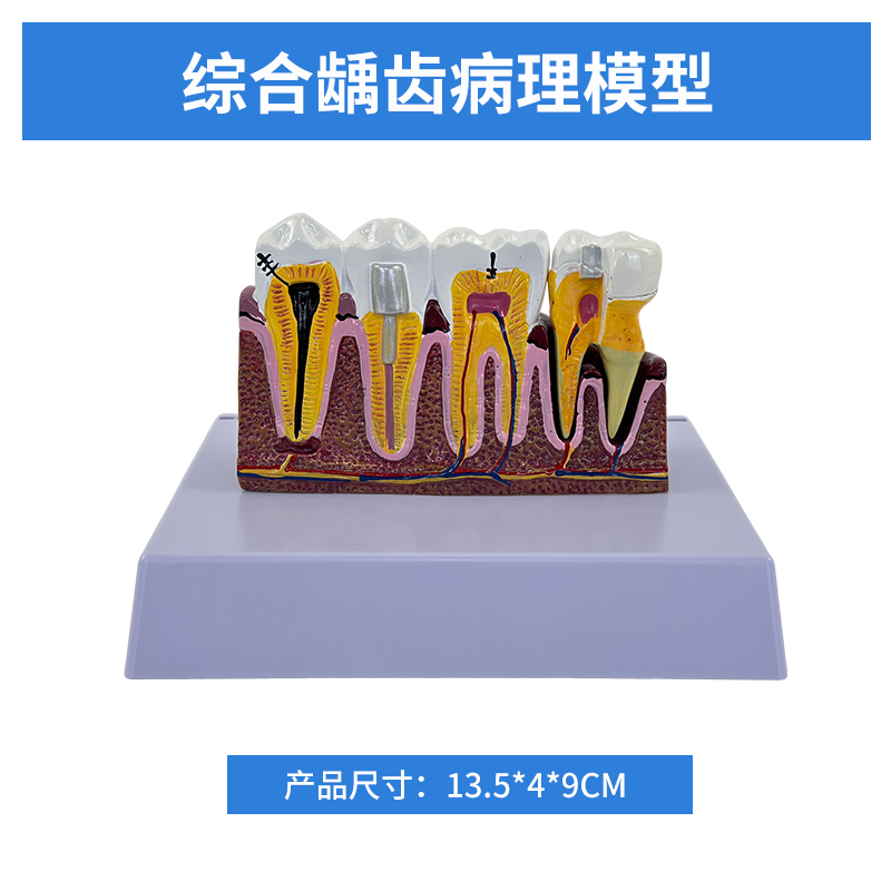Comprehensive dental caries pathological model-0