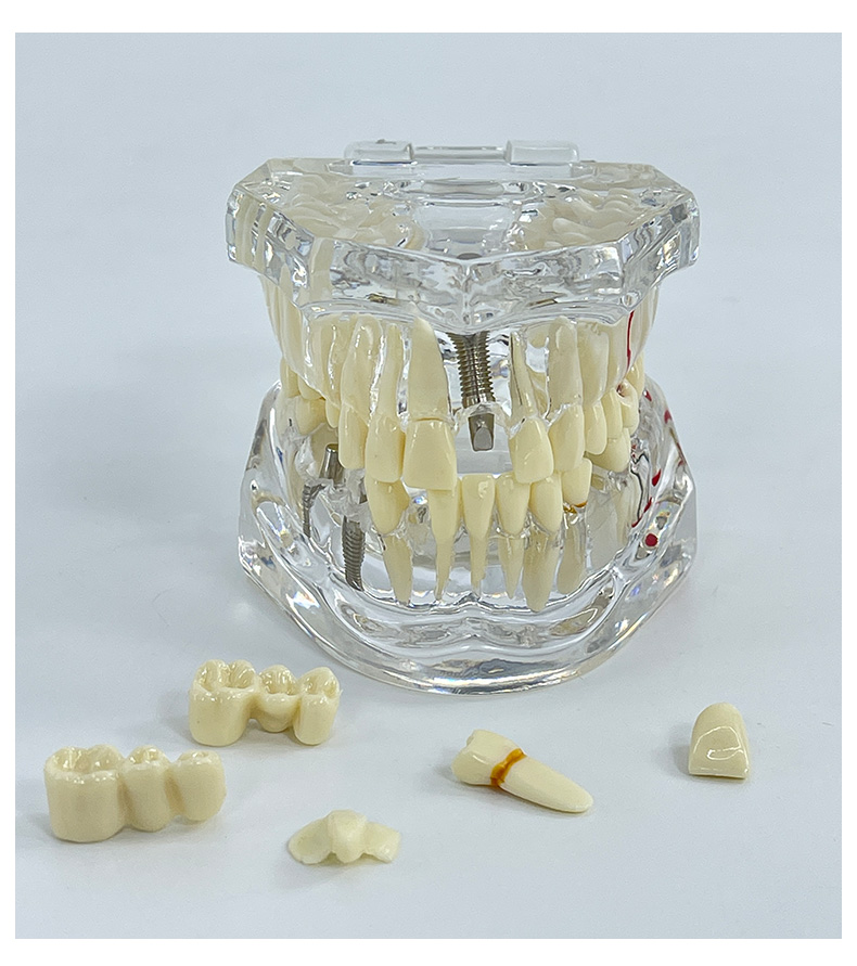 Transparent pathological tooth-1