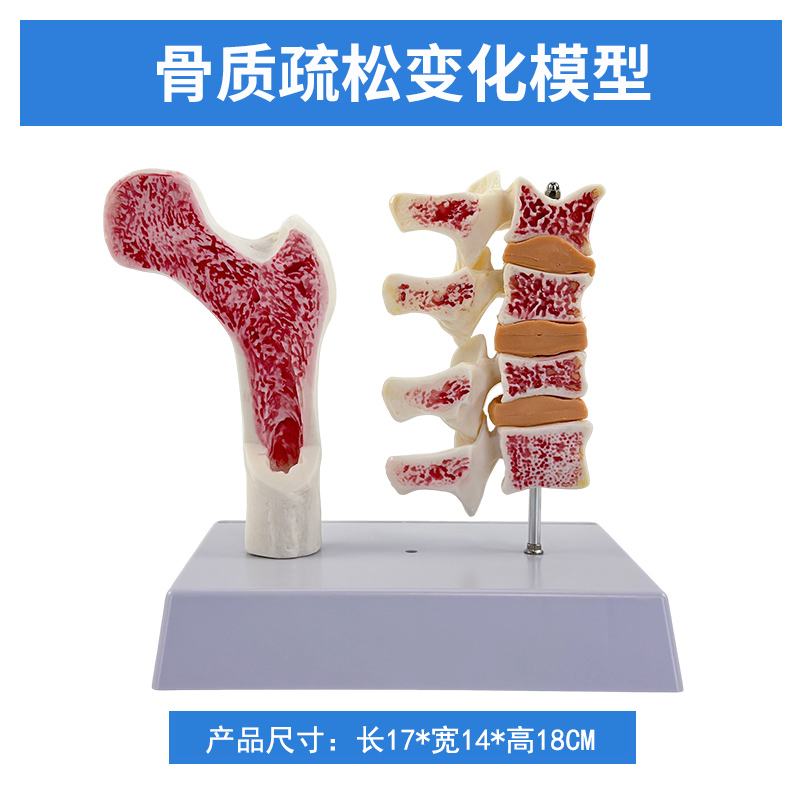 Osteoporosis (2 components)-0