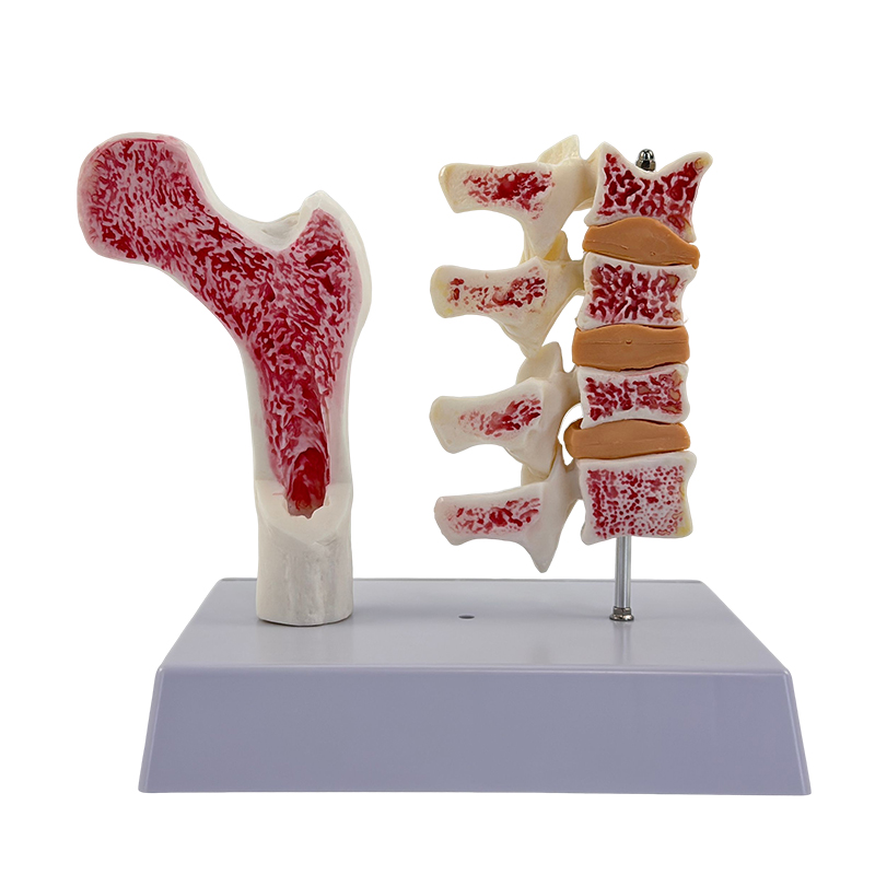 Osteoporosis (2 components)-1