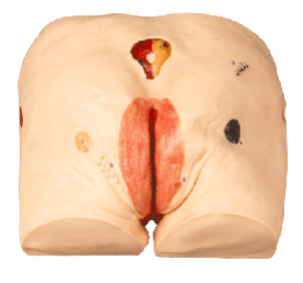 Pressure ulcer (bedsore) nursing model-0